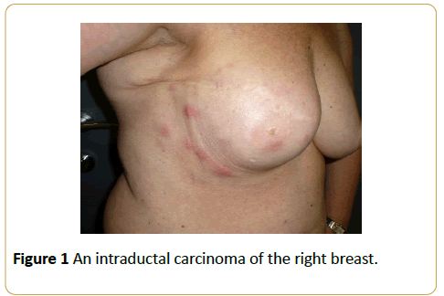 acanceresearch-intraductal-carcinoma-right breast